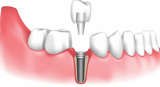 Dental implants