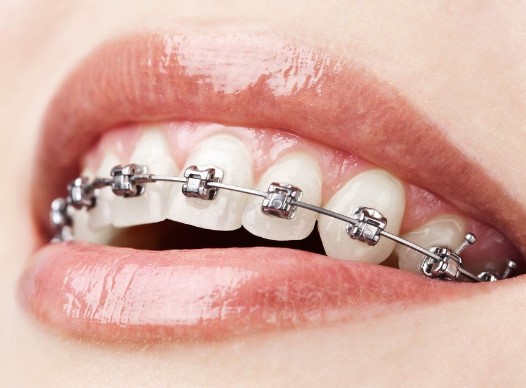 Orthodontics and braces