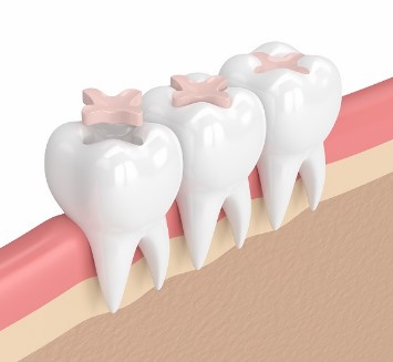 Fillings and restoration