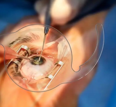 Cataract Surgery