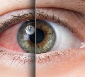 Glaucoma Treatment